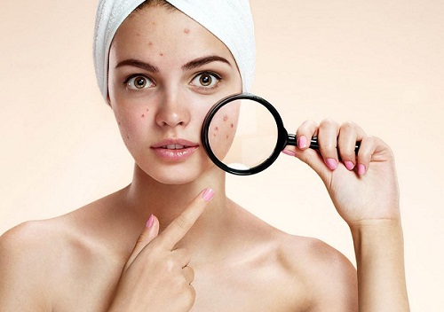 ผิวหน้าเป็นสิวอยู่จะสามารถใช้ครีมบำรุงผิวได้มั้ย 