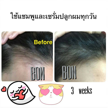 ผลิตภัณฑ์ดูแลเส้นผมและหนังศรีษะบอนบอน 