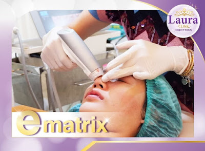 lauraclinic บริการรักษาหลุมสิวด้วยเลเซอร์ E-matrix เป็น ชื่อเครื่อง เลเซอร์รักษาหลุมสิว ที่เป็นที่นิยมที่สุดอันดับ 1 ของเมืองไทย