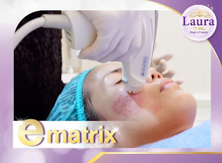 lauraclinic บริการรักษาหลุมสิวด้วยเลเซอร์ E-matrix เป็น ชื่อเครื่อง เลเซอร์รักษาหลุมสิว ที่เป็นที่นิยมที่สุดอันดับ 1 ของเมืองไทย